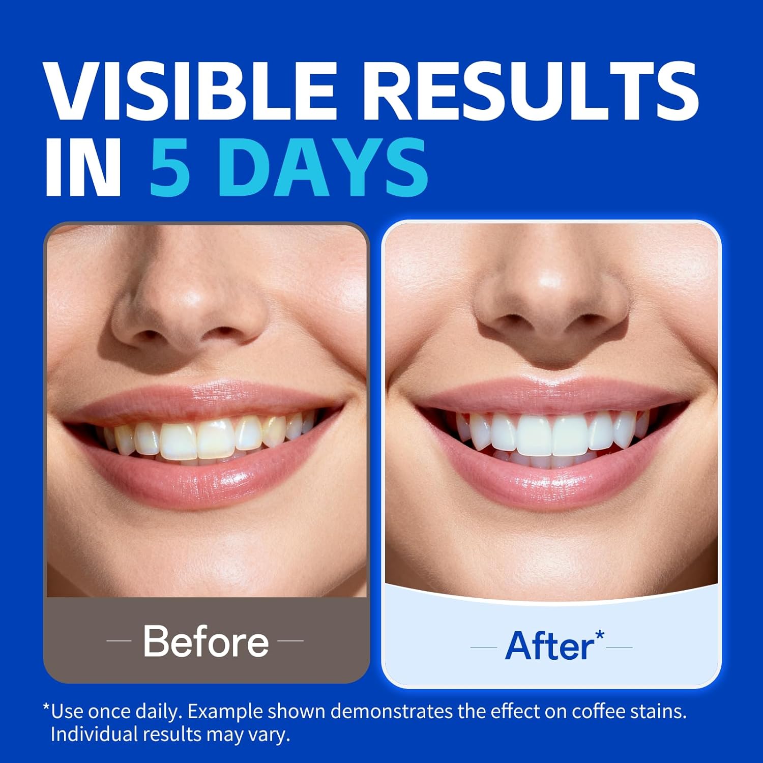 1/7 쌍의 치아 미백 스트립으로 더 하얗게 보이는 미 - Teeth Whitening Street 리뷰 및 가격
